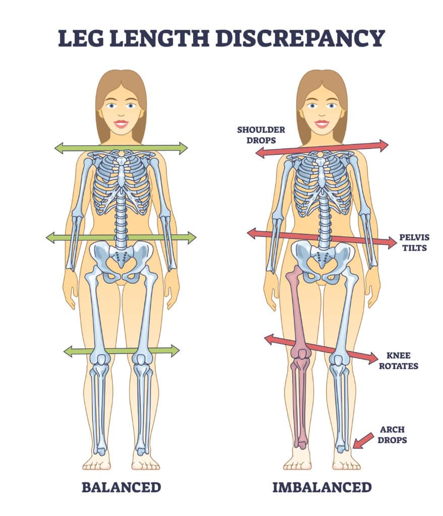 Leg Length Discrepancy: Ways You Can Correct It